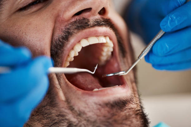 Best Emergency Wisdom Teeth Removal in Papillion, NE